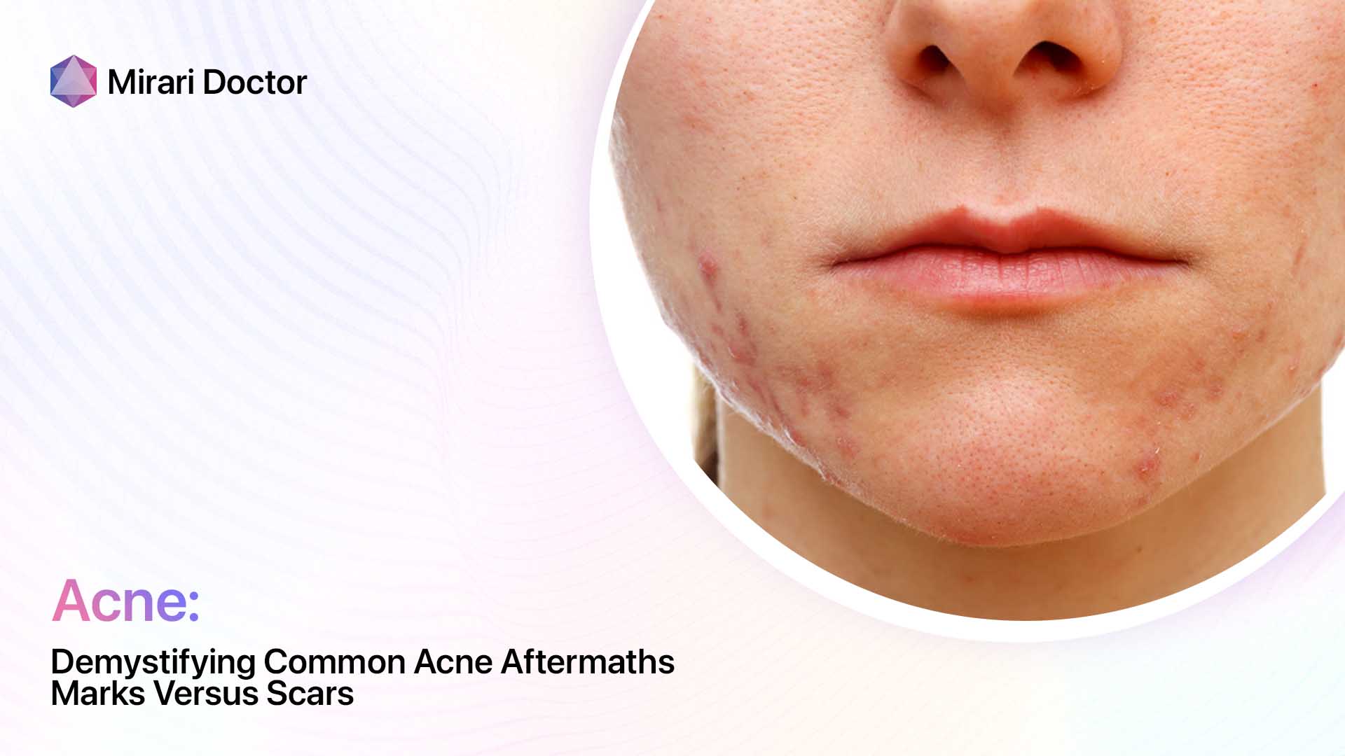 Demystifying Common Acne Aftermaths Marks Versus Scars