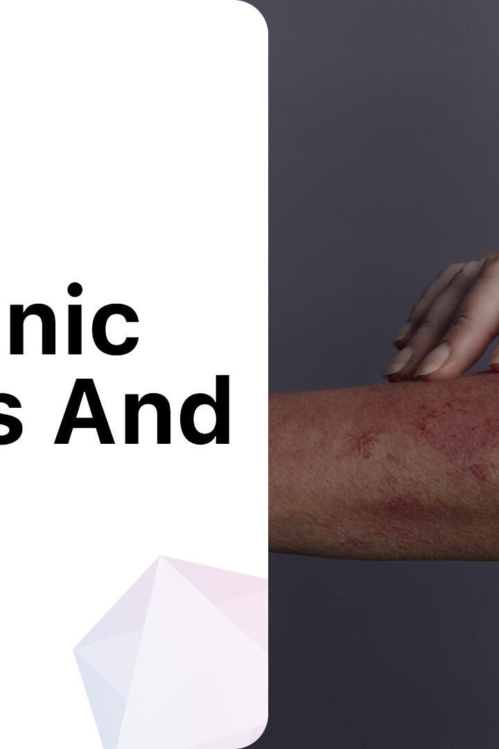 Understanding the Connection Between Pruritus and Lupus