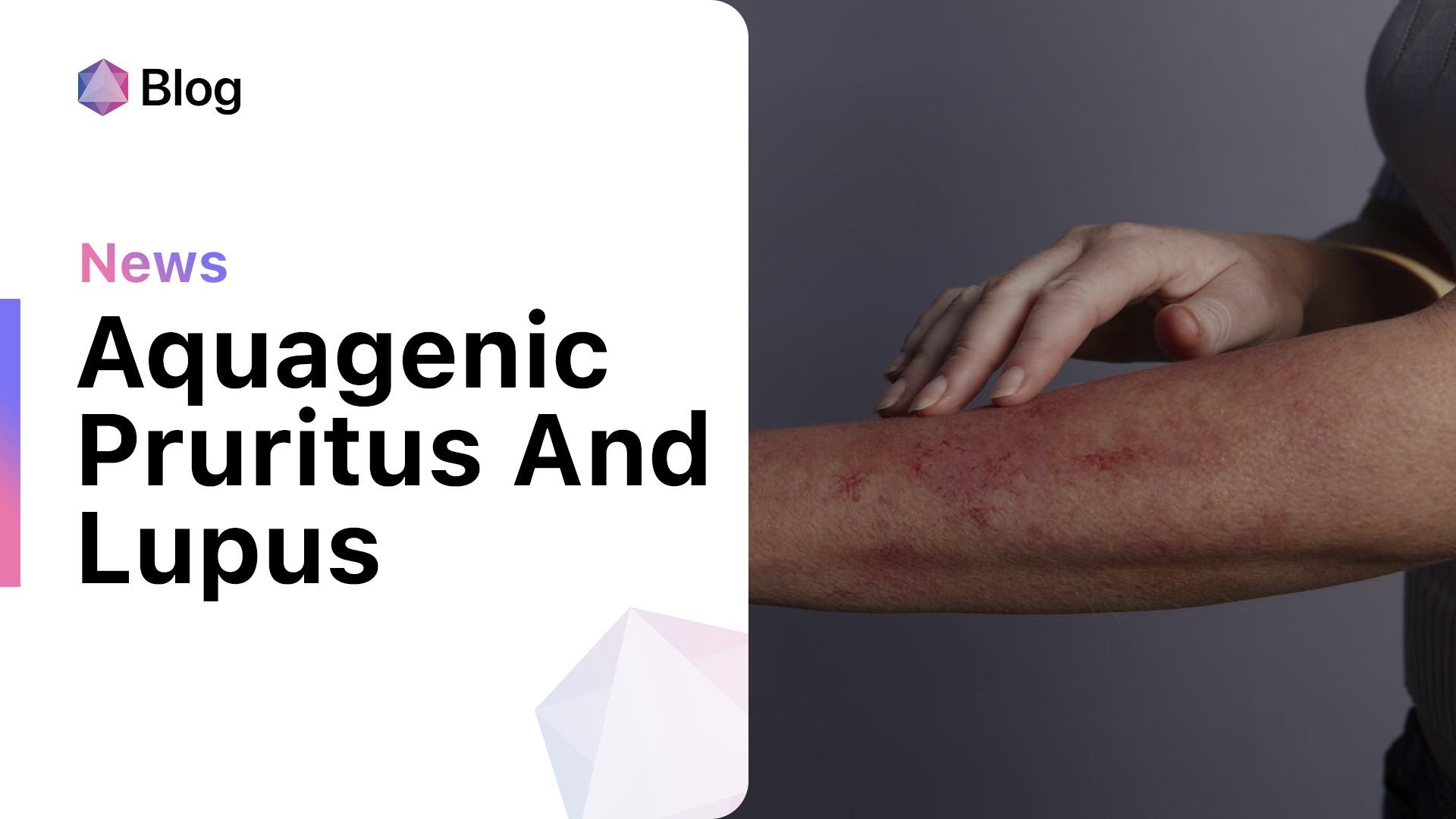 Understanding the Connection Between Pruritus and Lupus