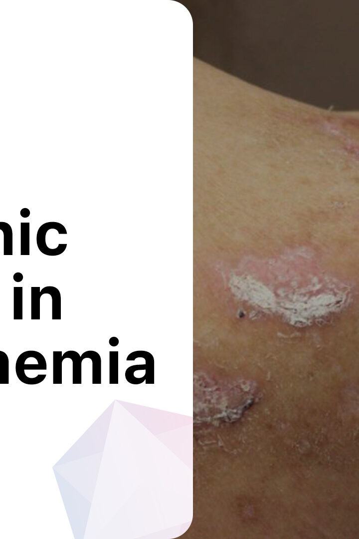 gabapentin induced pruritus