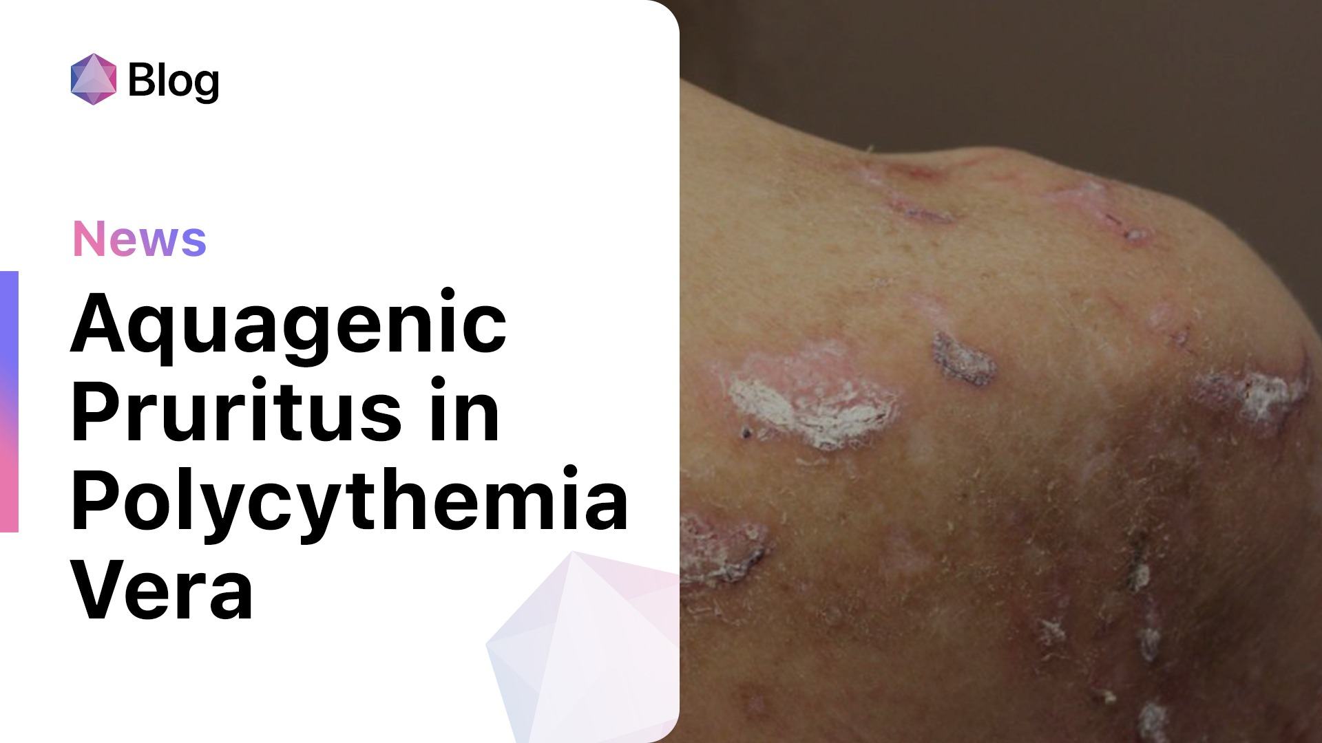 gabapentin induced pruritus
