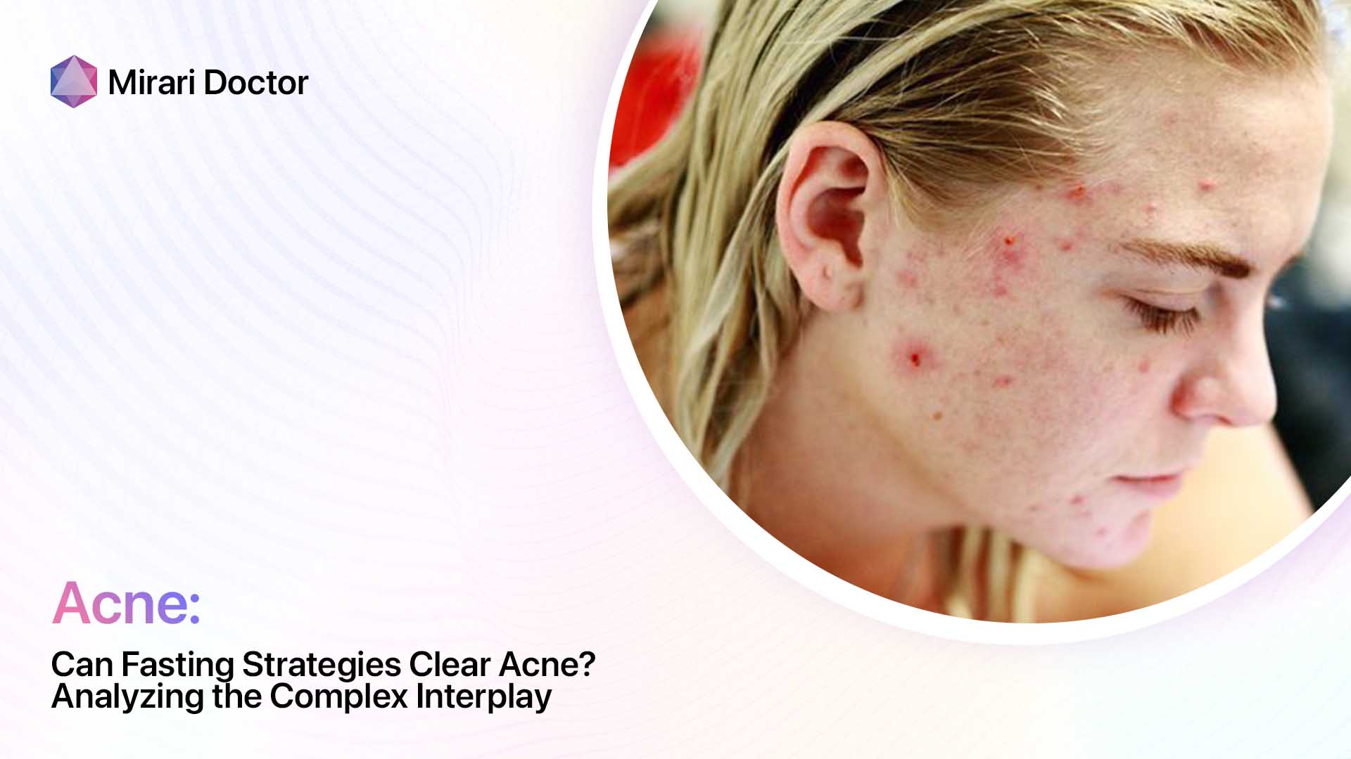 Can Fasting Strategies Clear Acne? Analyzing the Complex Interplay