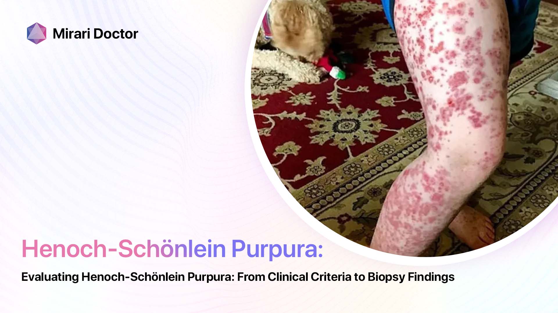 Evaluating Henoch Schönlein Purpura From Clinical Criteria To Biopsy Findings