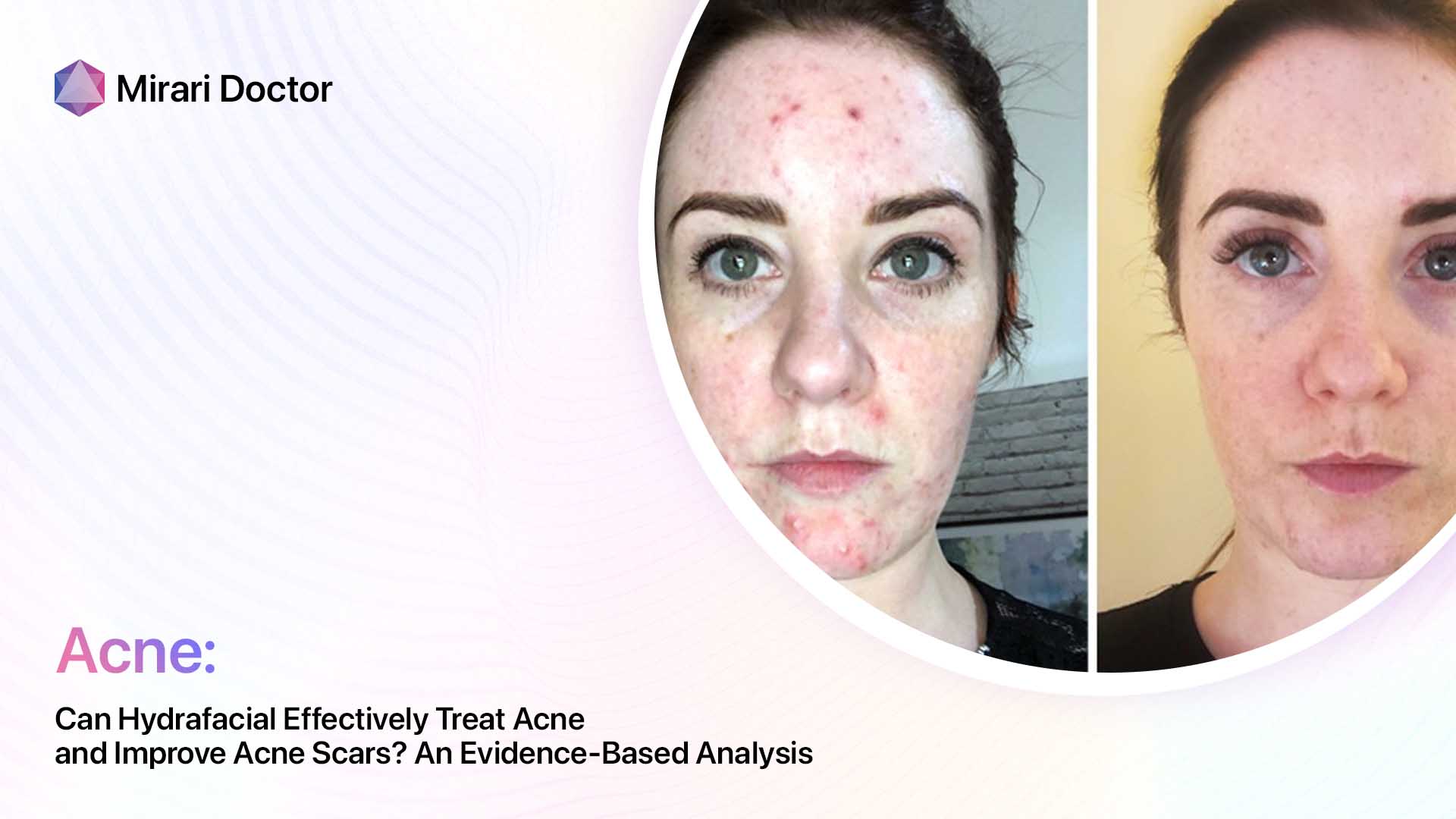 Featured image for “Can Hydrafacial Effectively Treat Acne and Improve Acne Scars? An Evidence-Based Analysis”
