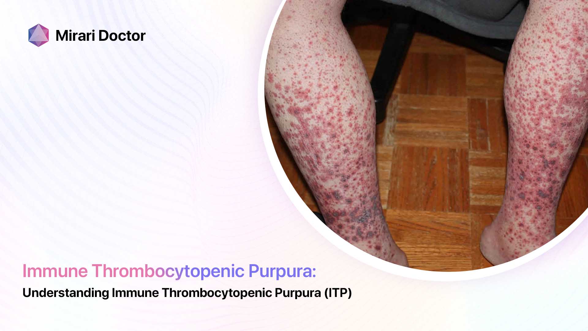 Featured image for “Understanding Immune Thrombocytopenic Purpura (ITP) and its ICD-10 Code Classification”