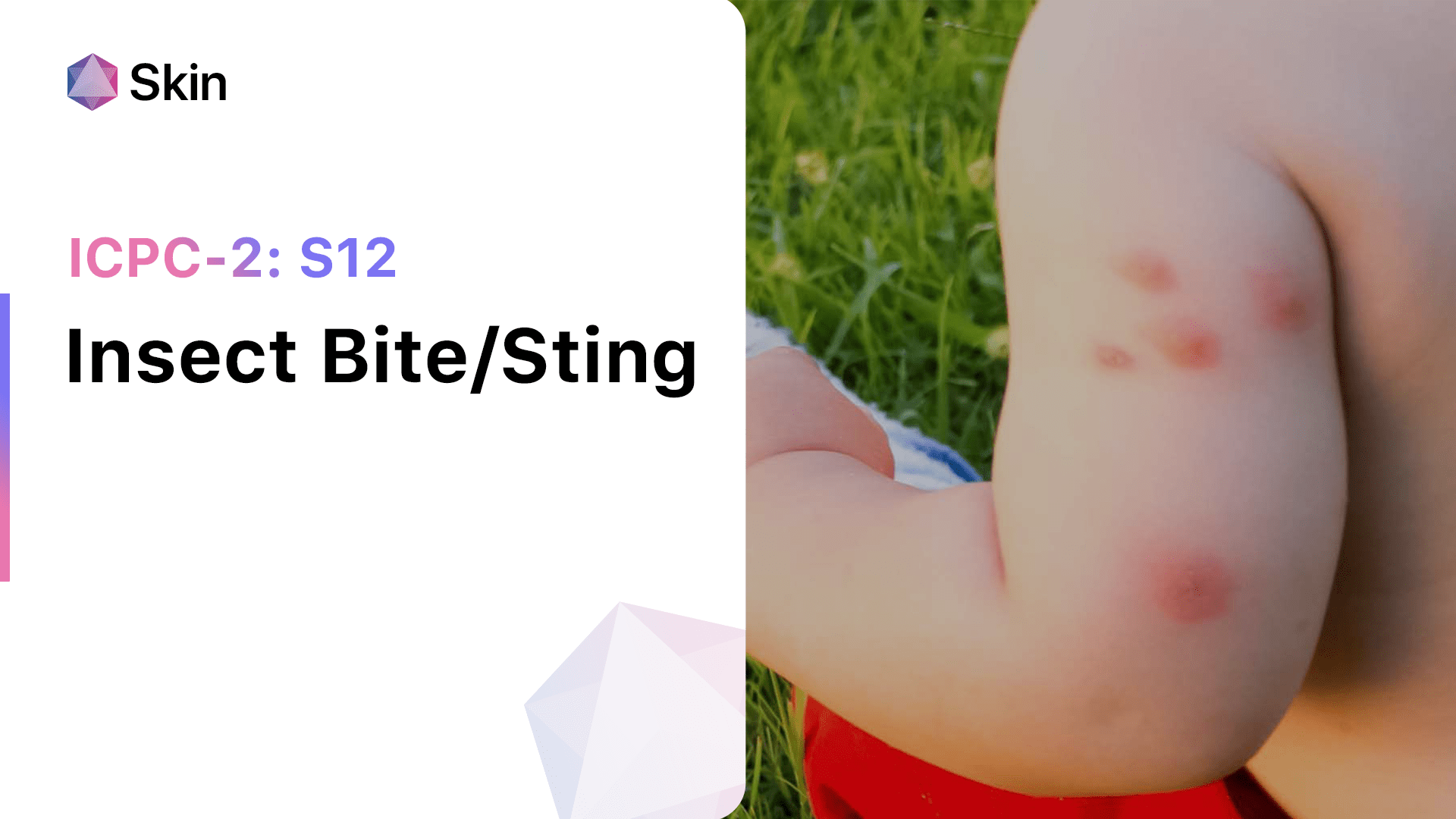 Insect Bite/Sting (ICPC2 S12)