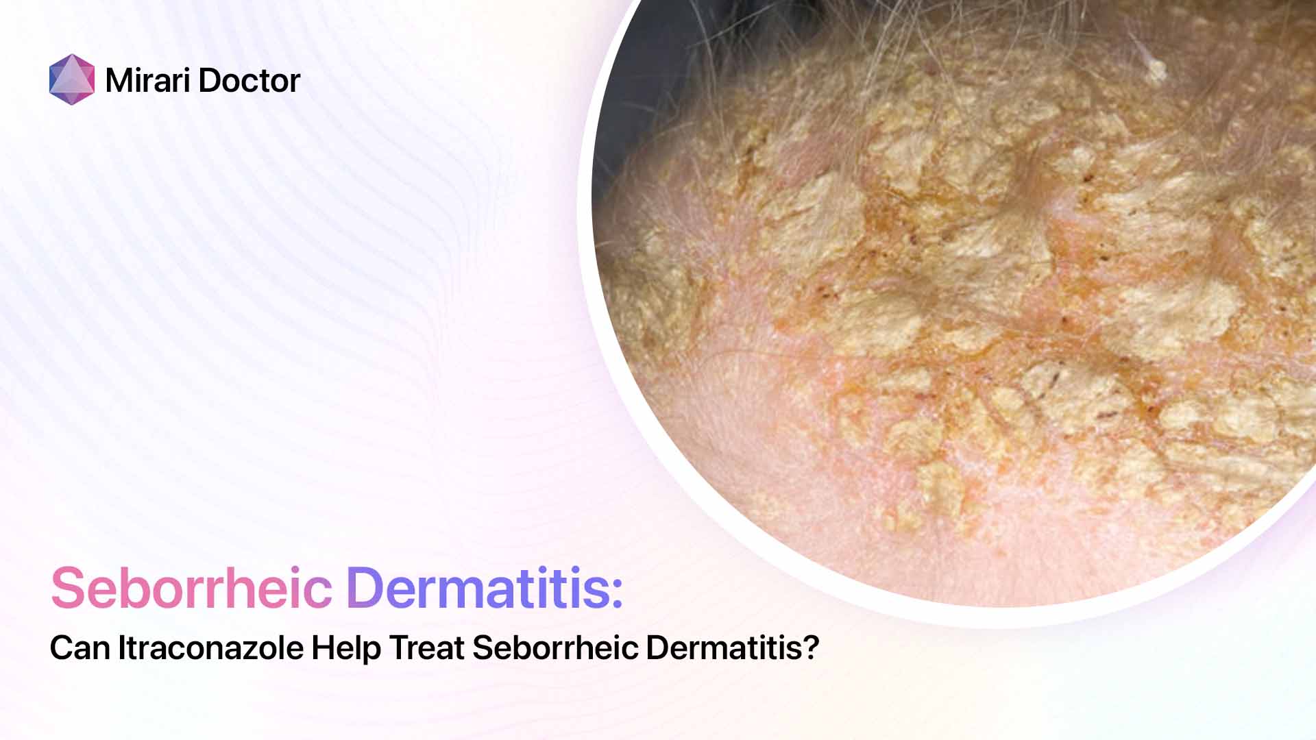 Featured image for “Can Itraconazole Help Treat Seborrheic Dermatitis?”