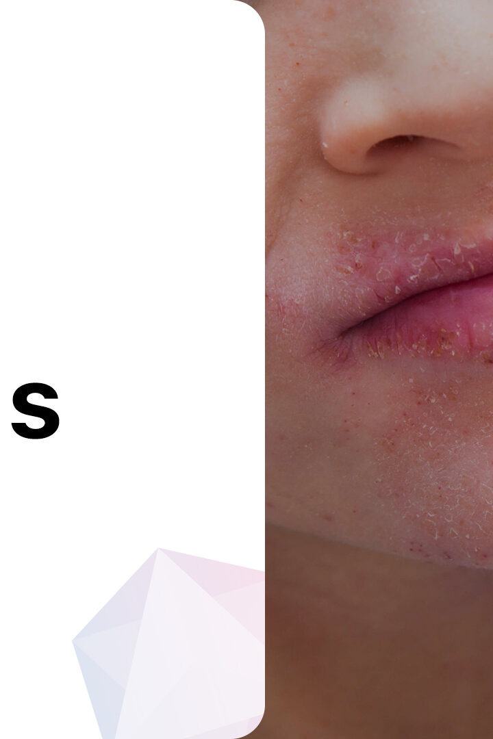 Demystifying Lip Itching A Clinical Guide to Pruritus Affecting the Mouth