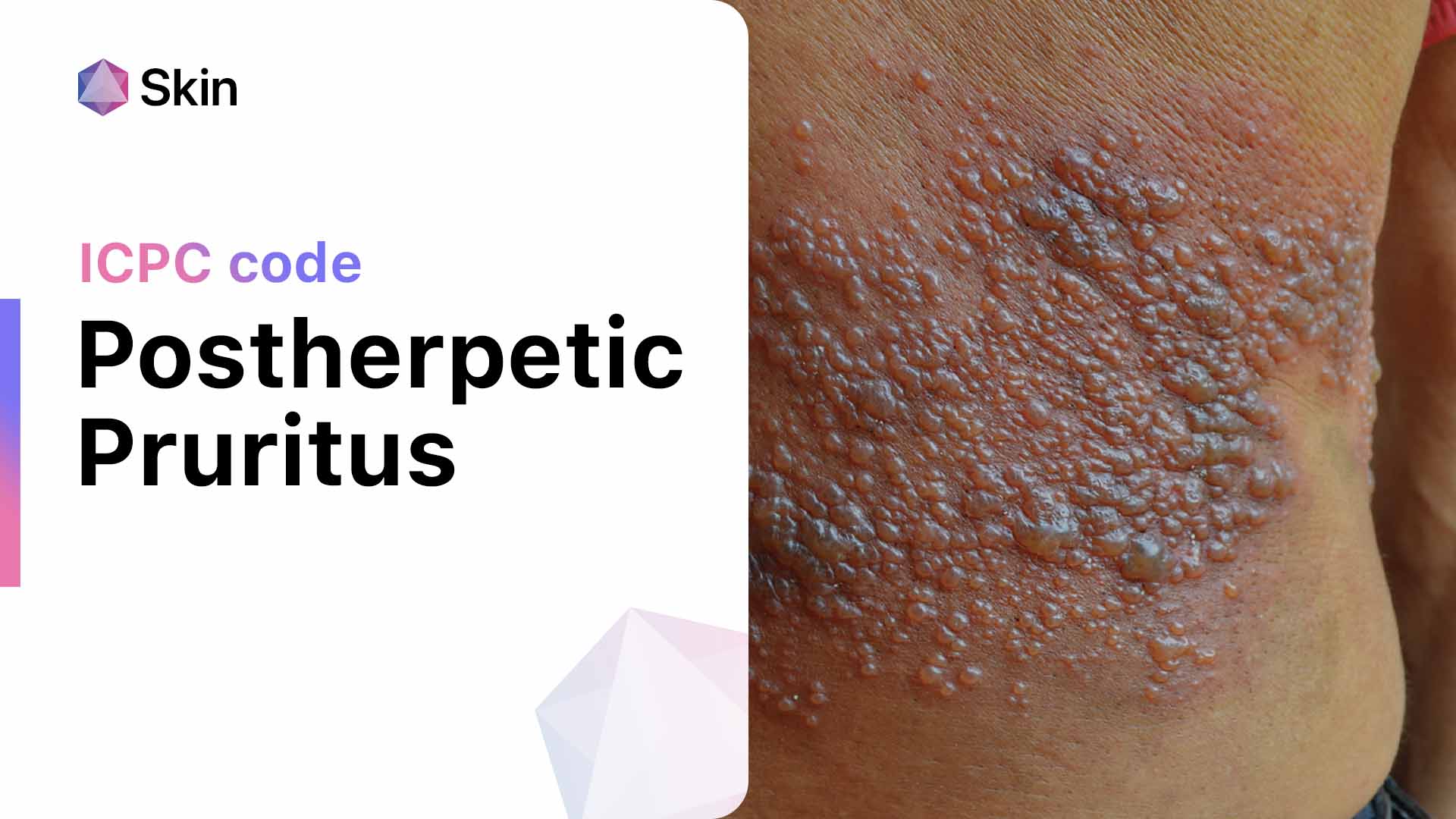 Treating Seborrheic Dermatitis with Fluconazole