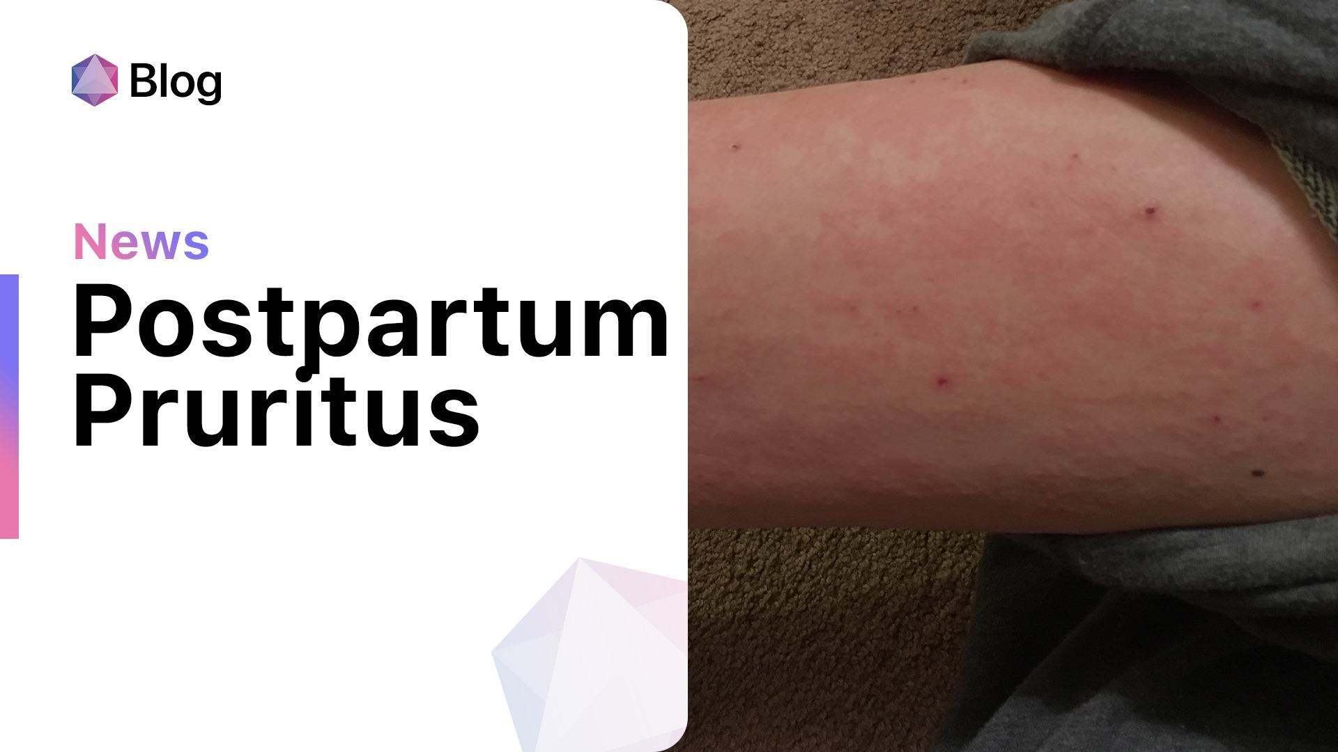 Decoding Postpartum Itching A Clinical Guide to Pruritus After Pregnancy