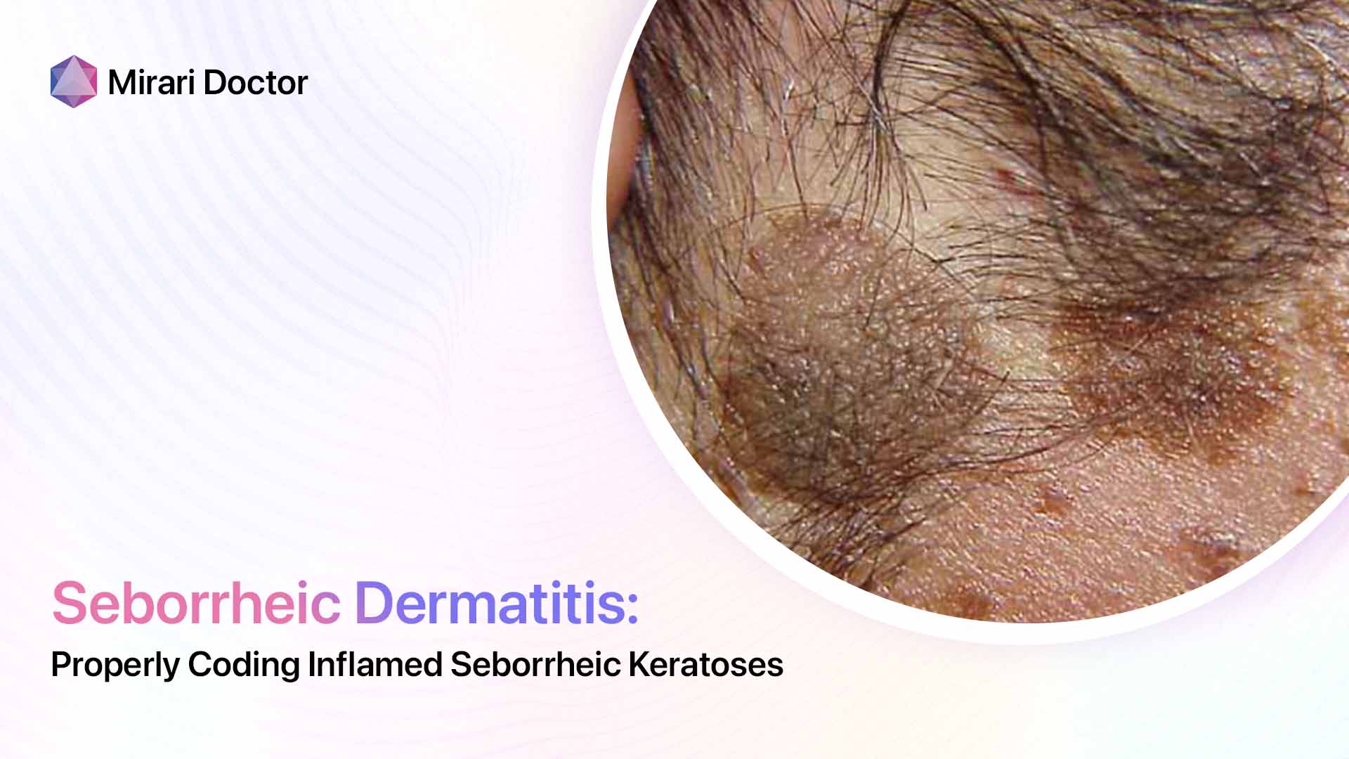 Featured image for “Properly Coding Inflamed Seborrheic Keratoses”