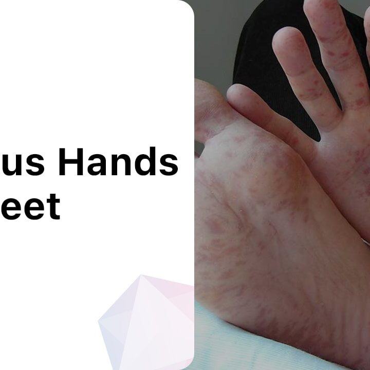 when-palms-and-soles-itch-evaluating-pruritus-of-the-hands-and-feet