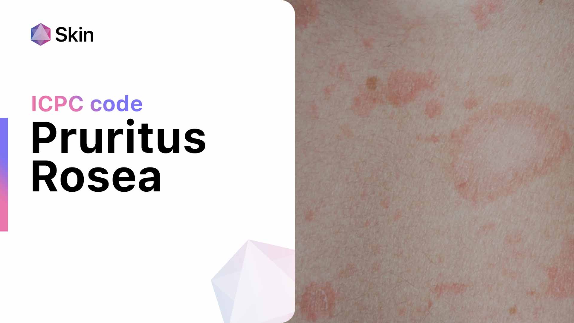 Demystifying Pityriasis Rosea Causes Presentation And Evidence Based