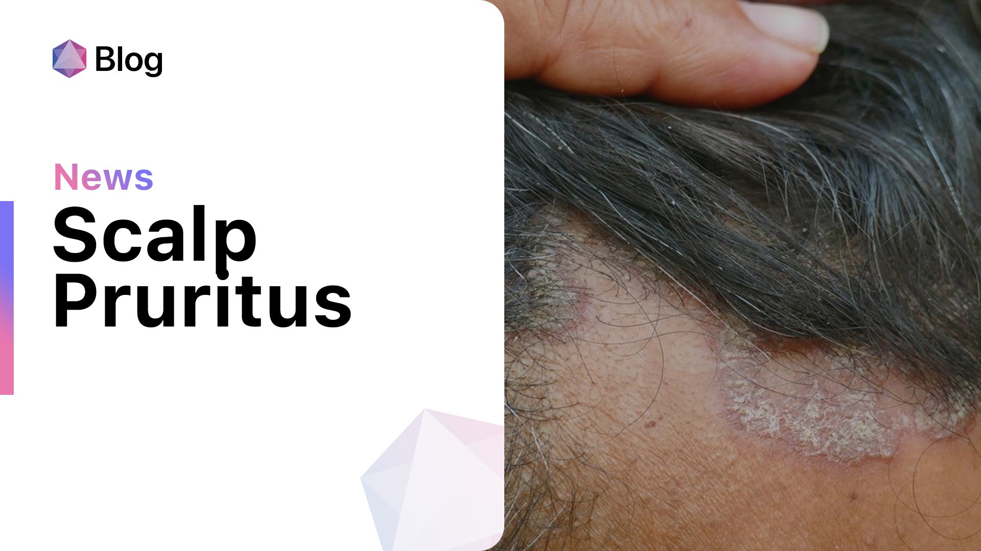 Demystifying Scalp Itching An In Depth Guide To Pruritus Of The Scalp 