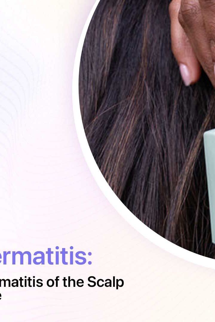 Treating Seborrheic Dermatitis Of The Scalp A Comprehensive Guide