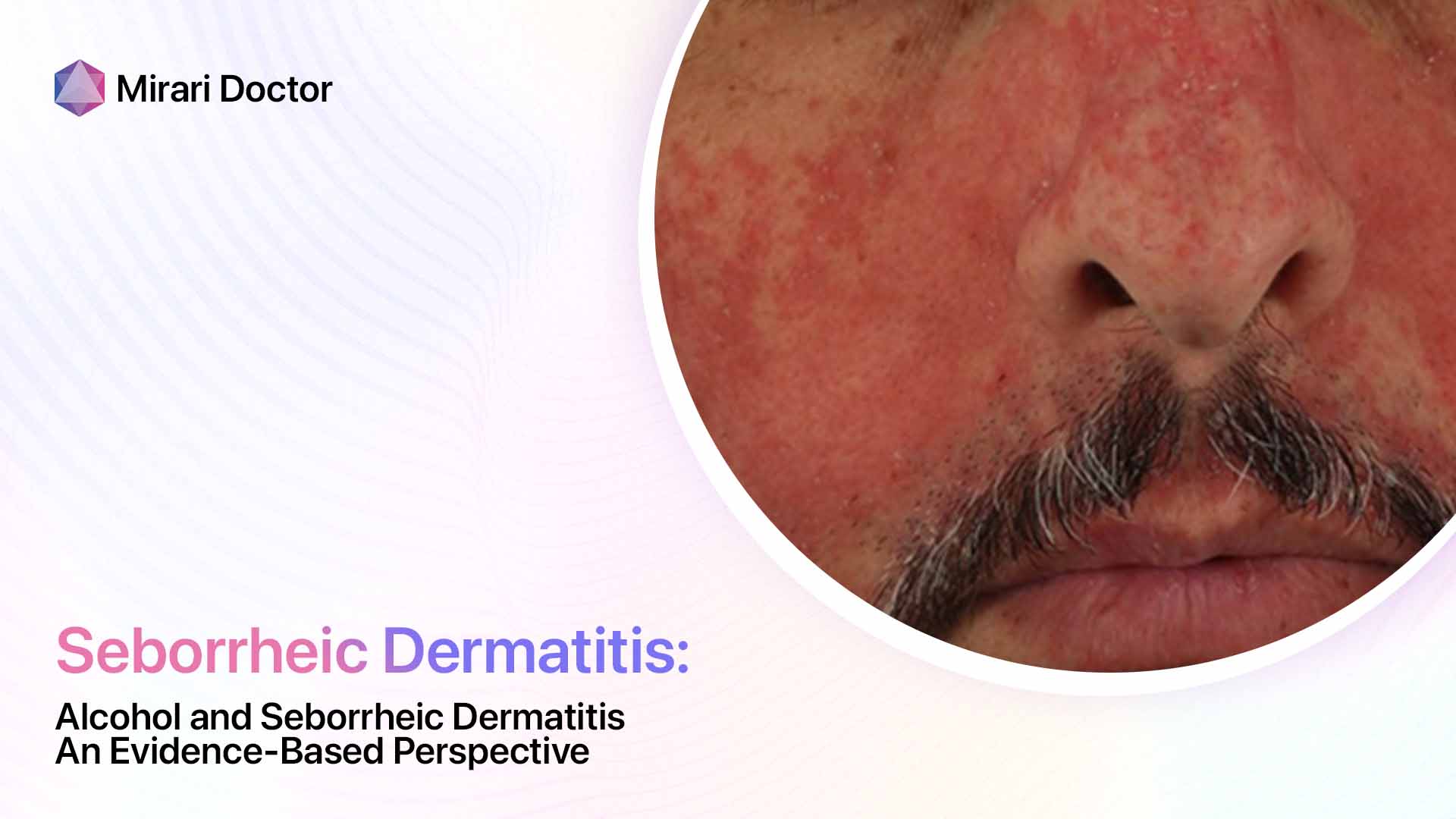 Featured image for “Alcohol and Seborrheic Dermatitis: An Evidence-Based Perspective”