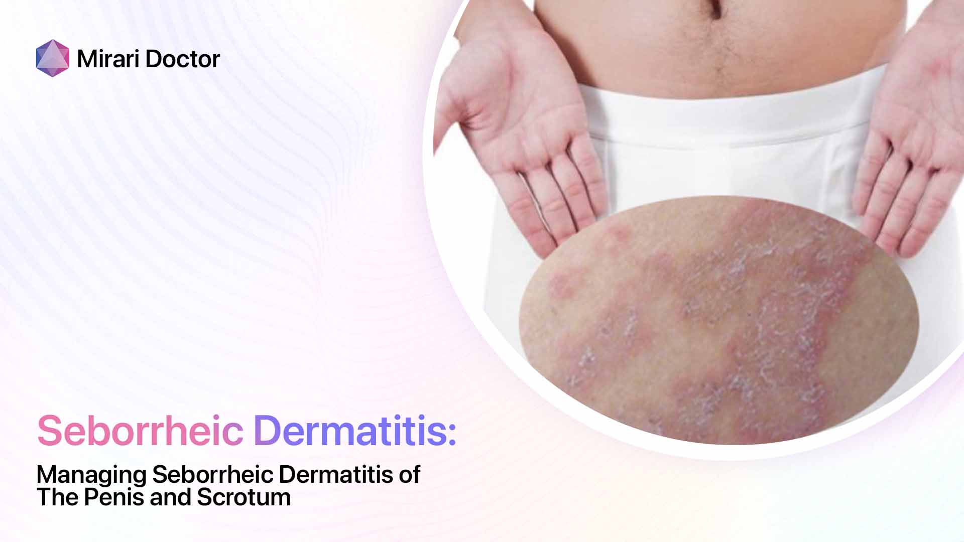 Featured image for “Managing Seborrheic Dermatitis of the Penis and Scrotum”
