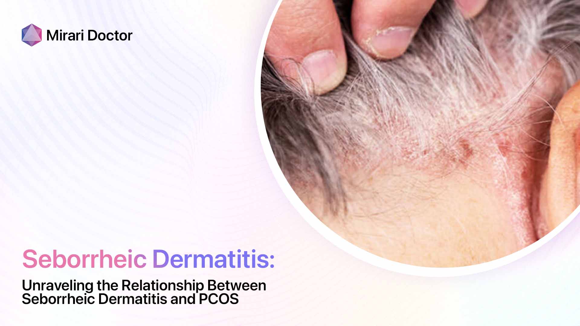 Featured image for “Unraveling the Relationship Between Seborrheic Dermatitis and PCOS”
