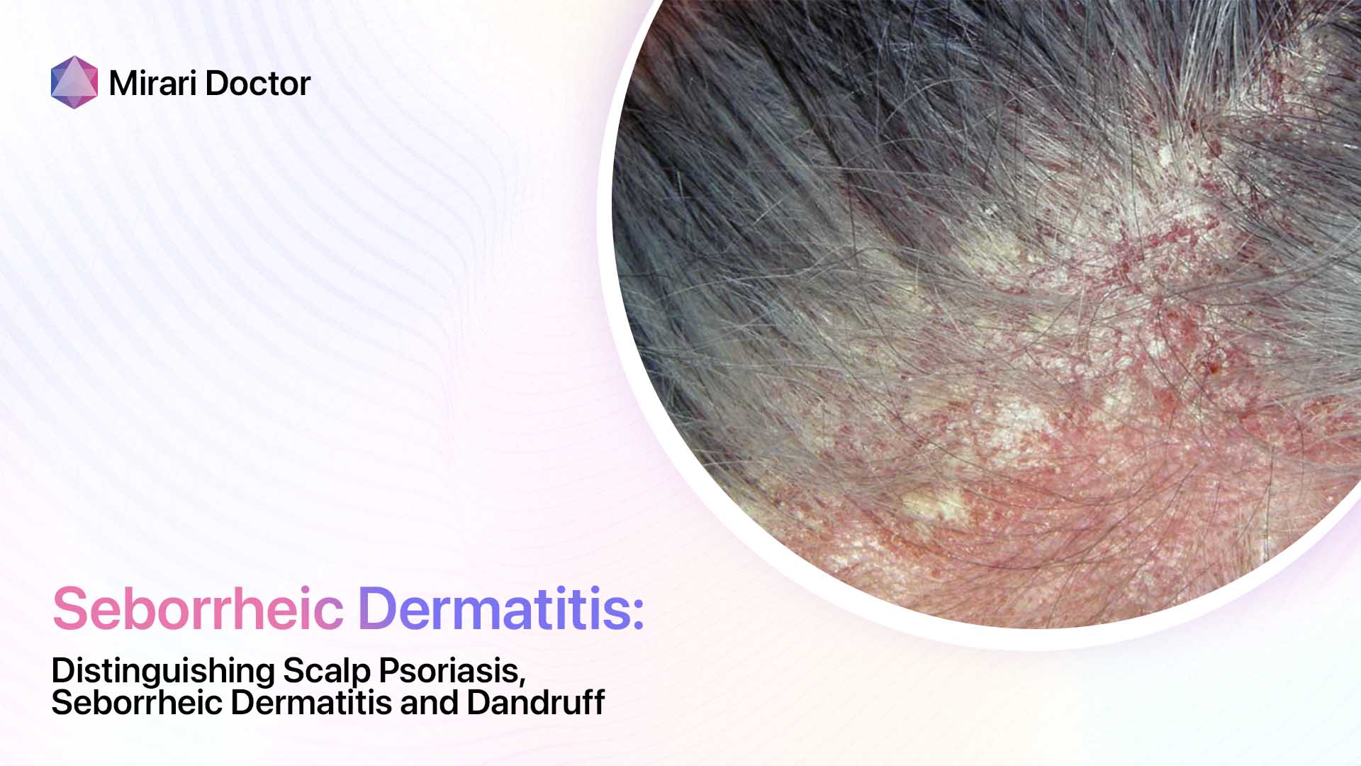 Distinguishing Scalp Psoriasis Seborrheic Dermatitis And Dandruff