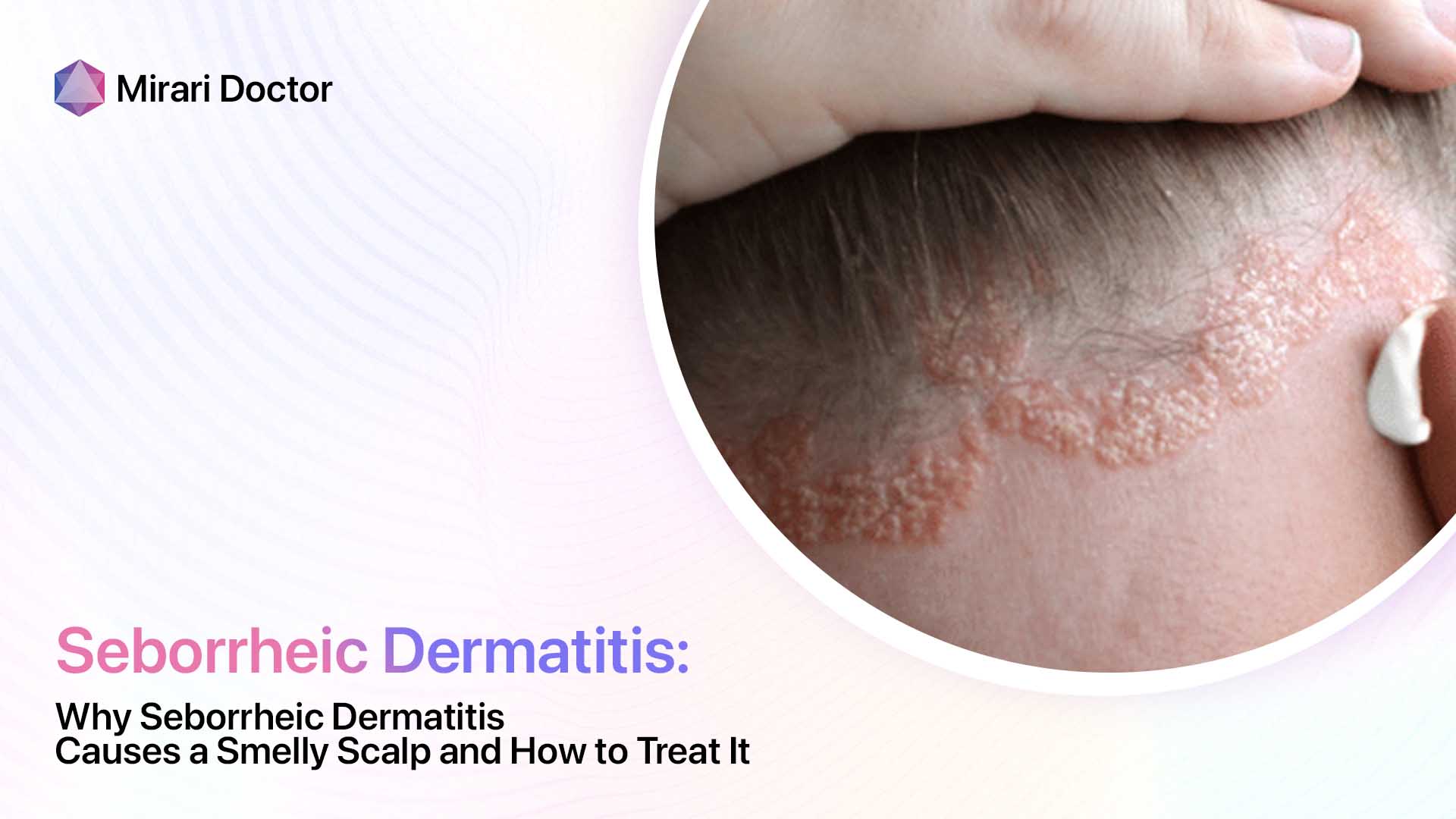 Featured image for “Why Seborrheic Dermatitis Causes a Smelly Scalp and How to Treat It”