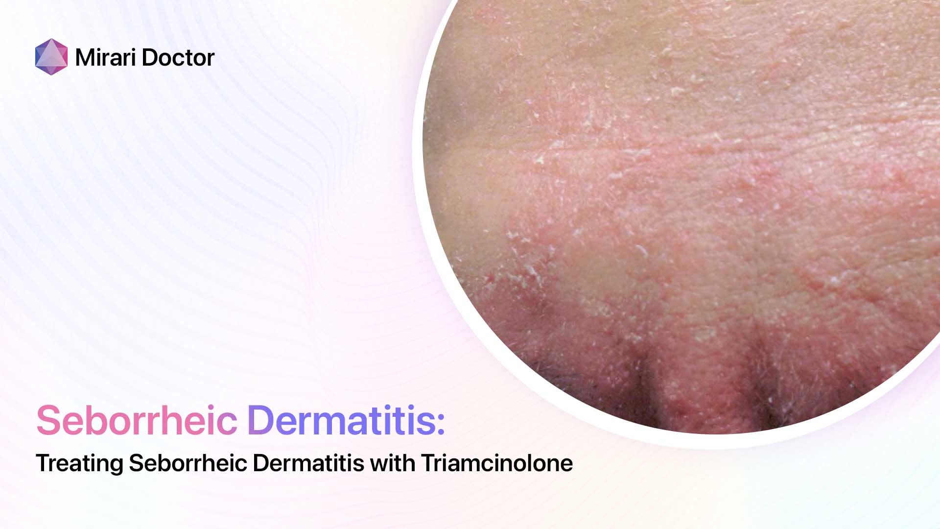Featured image for “Treating Seborrheic Dermatitis with Triamcinolone”