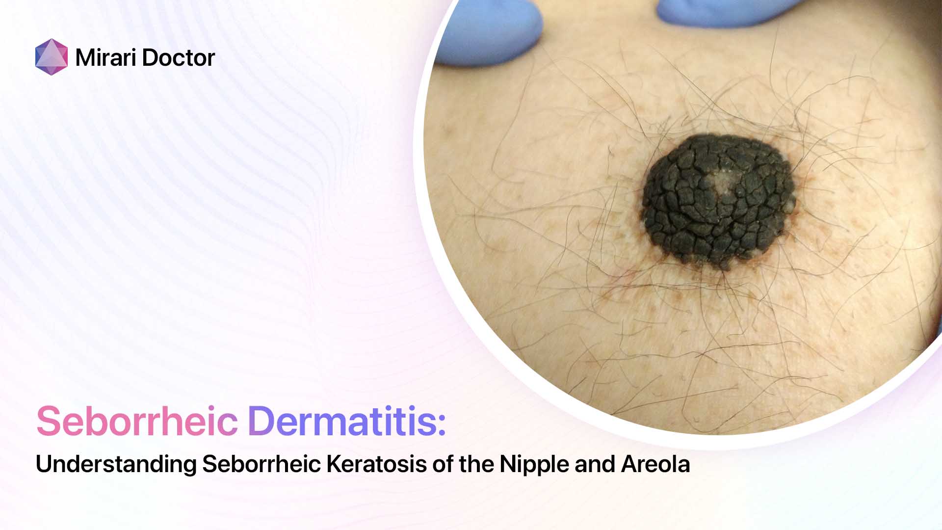 Featured image for “Understanding Seborrheic Keratosis of the Nipple and Areola”