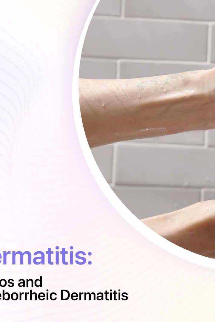 Choosing Ideal Shampoos and Conditioners Battling Seborrheic Dermatitis