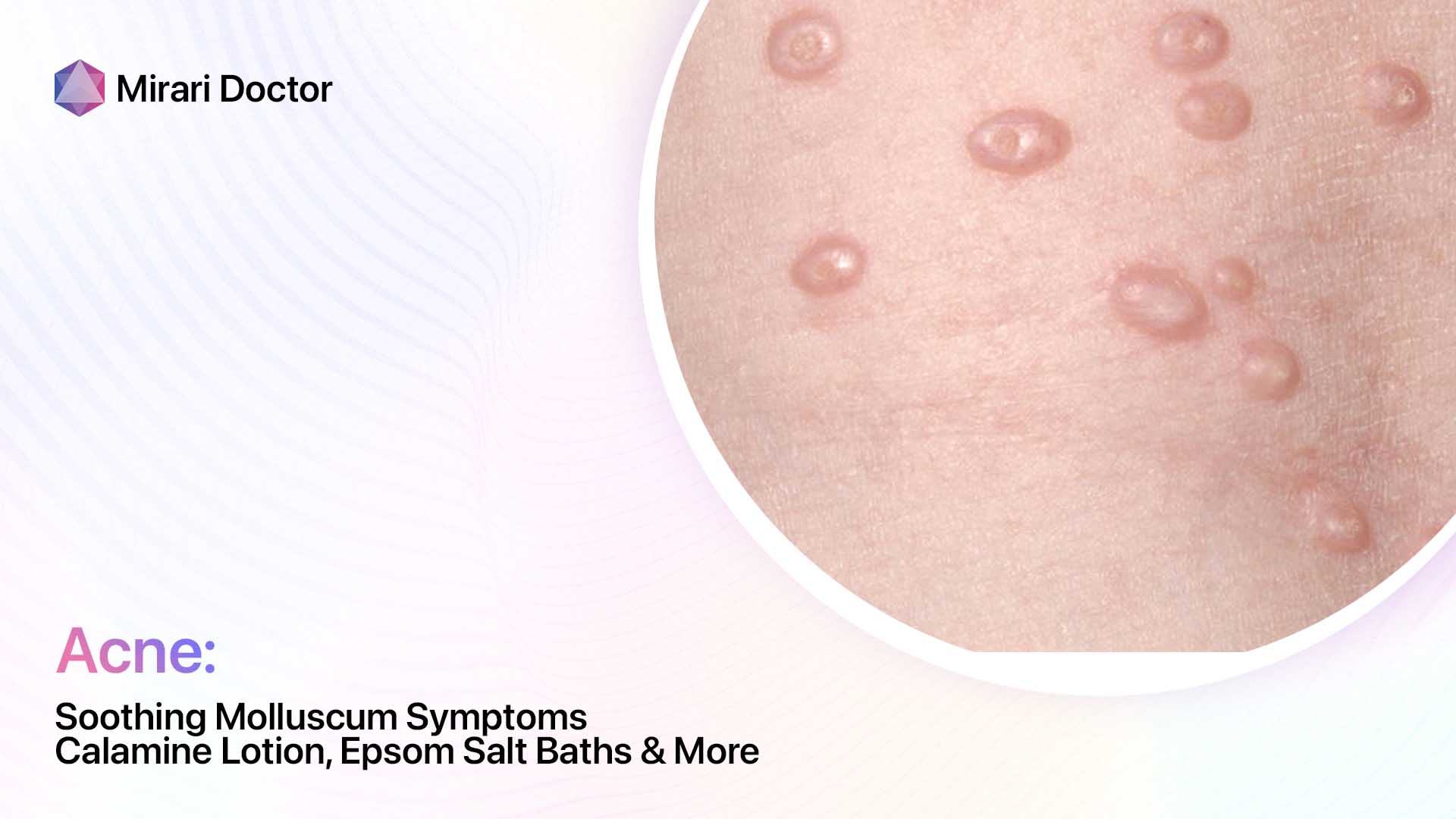 Featured image for “Soothing Molluscum Symptoms: Calamine Lotion, Epsom Salt Baths & More”