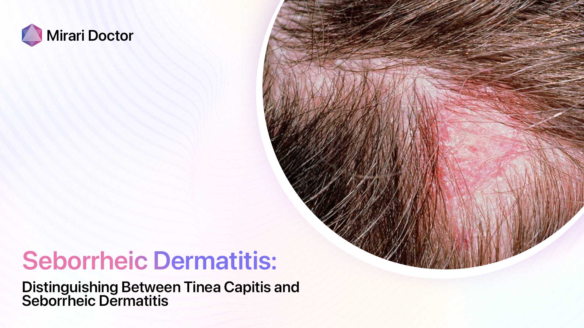 Featured image for “Distinguishing Between Tinea Capitis and Seborrheic Dermatitis”
