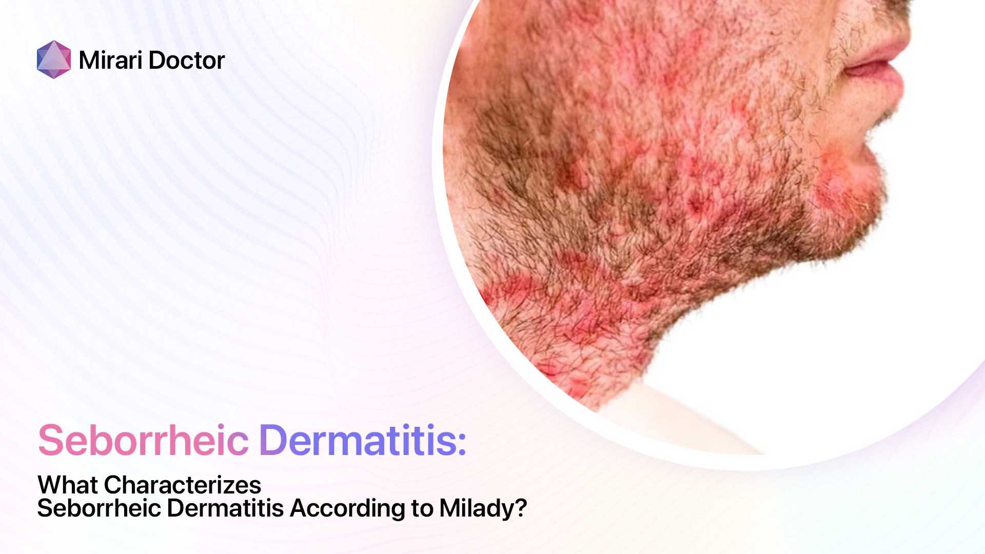 Featured image for “What Characterizes Seborrheic Dermatitis According to Milady?”