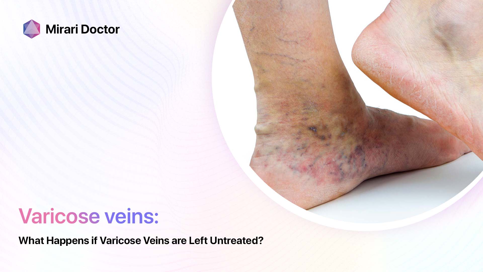 What Happens If Varicose Veins Are Left Untreated 
