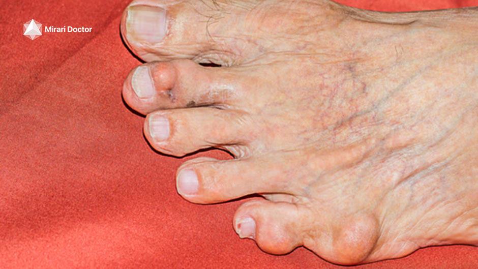 Gout in Pinky Toe: Symptoms and Effective Relief