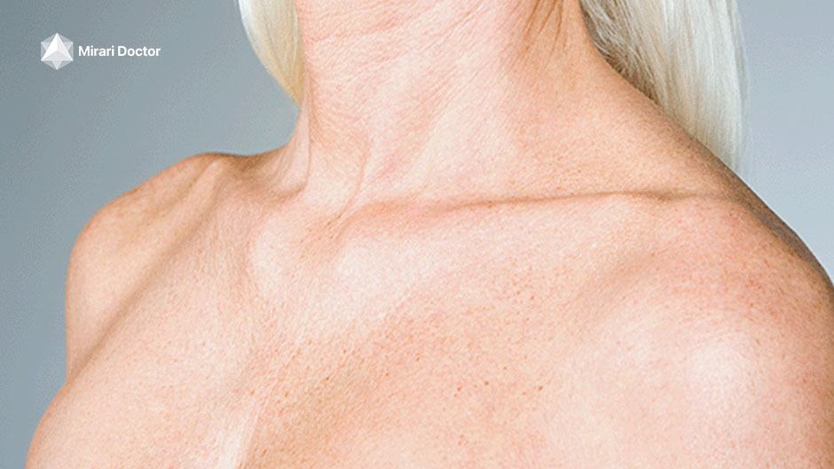 Managing Varicose Veins on the Chest and Breast Area