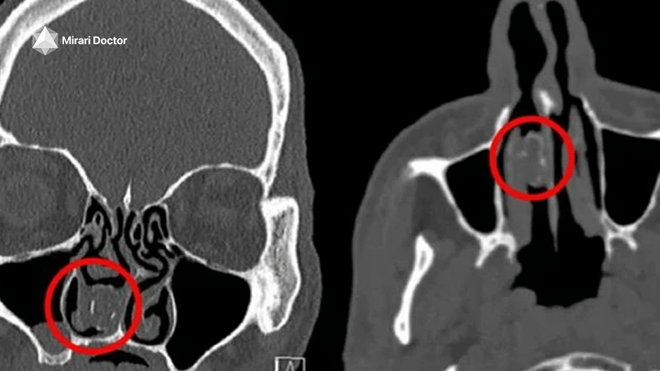 What Does Chronic Sinusitis Look Like On A Ct Scan