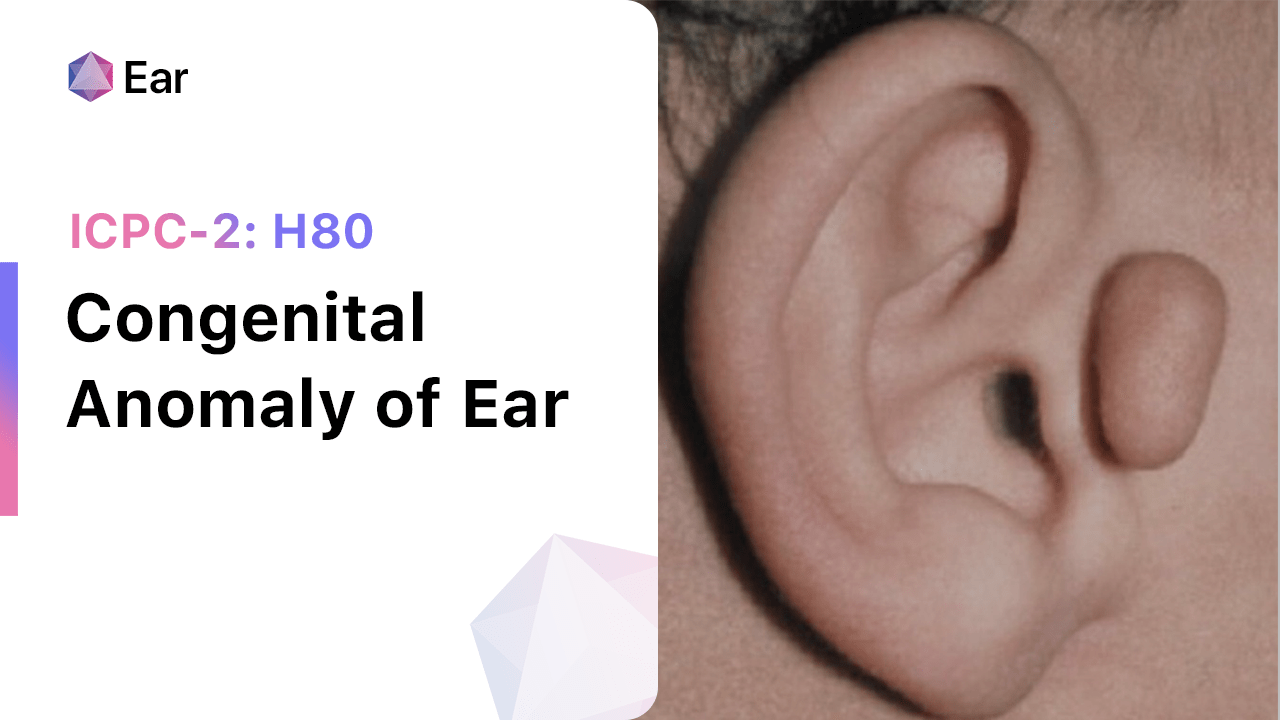 Congenital Anomaly of Ear (ICPC-2: H80)