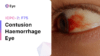 F75 Contusion/haemorrhage eye (ICD-10:S05.1)