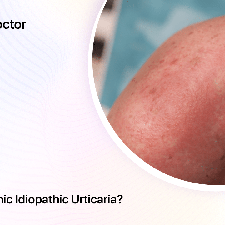 What Is Chronic Idiopathic Urticaria