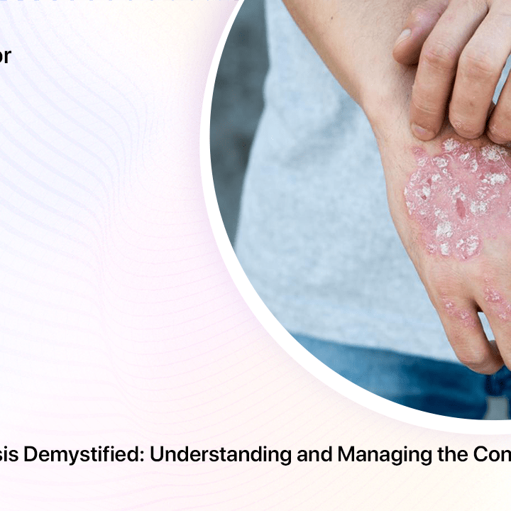 Keratosis Psoriasis Demystified: Understanding and Managing the Condition