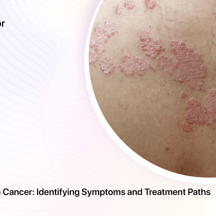 Psoriasis vs. Skin Cancer: Identifying Symptoms and Treatment Paths