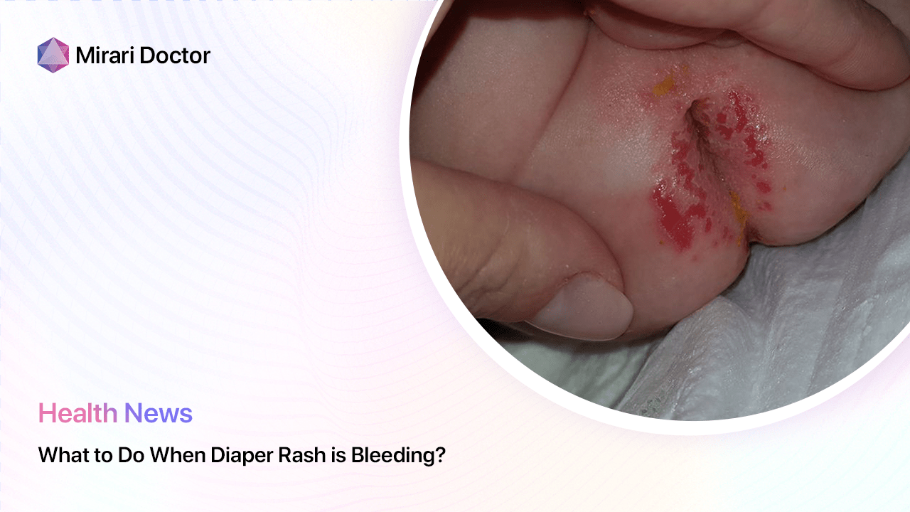Featured image for “What to Do When Diaper Rash is Bleeding?”