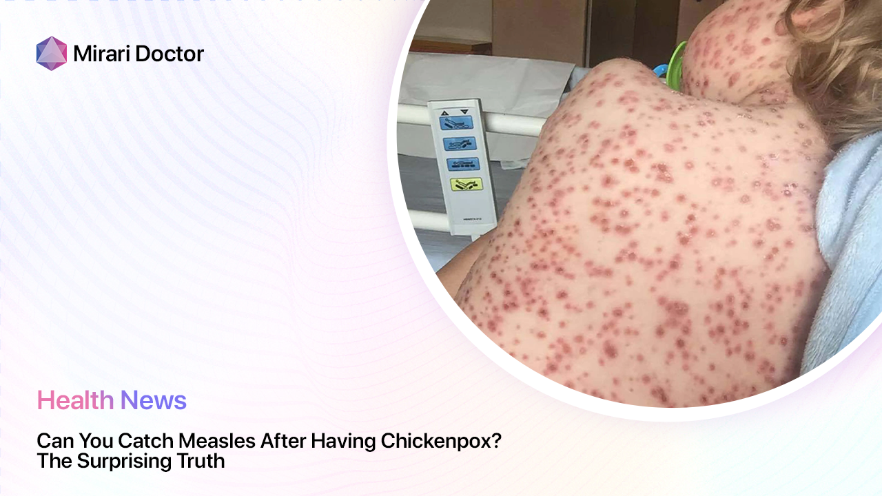 Featured image for “Can You Catch Measles After Having Chickenpox? The Surprising Truth”