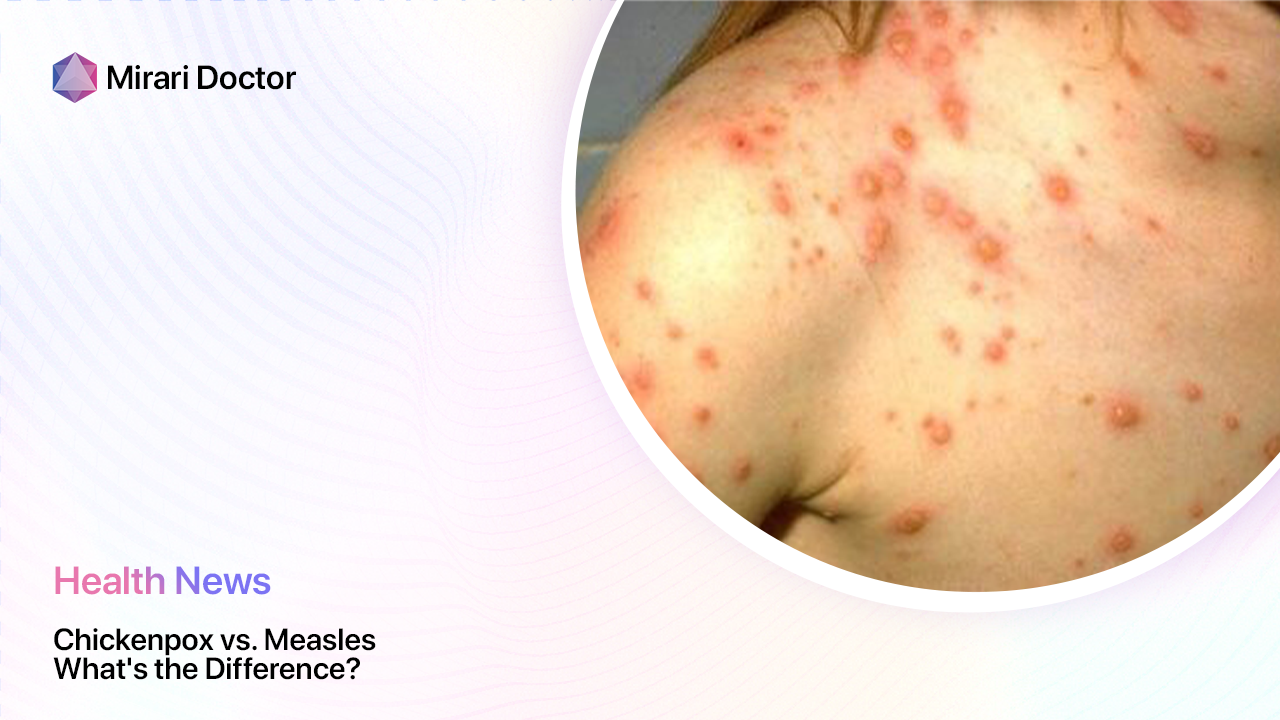 Featured image for “Chickenpox vs. Measles: What’s the Difference?”