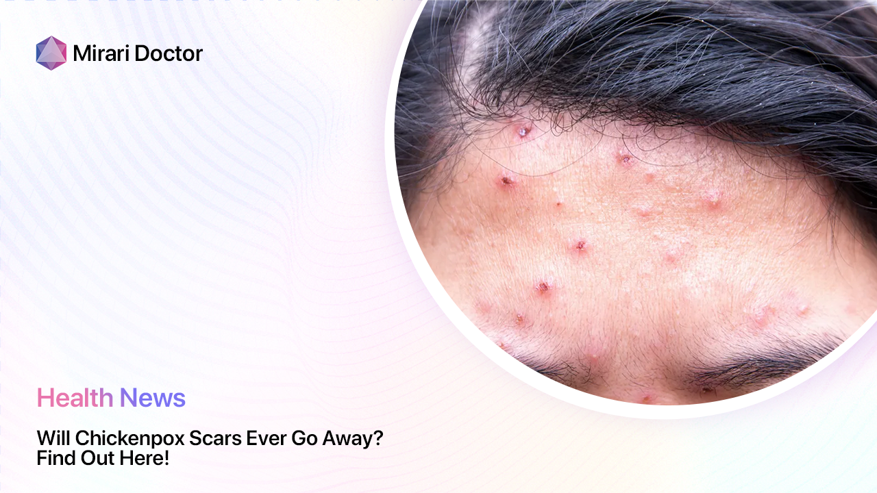 Featured image for “Will Chickenpox Scars Ever Go Away? Find Out Here!”