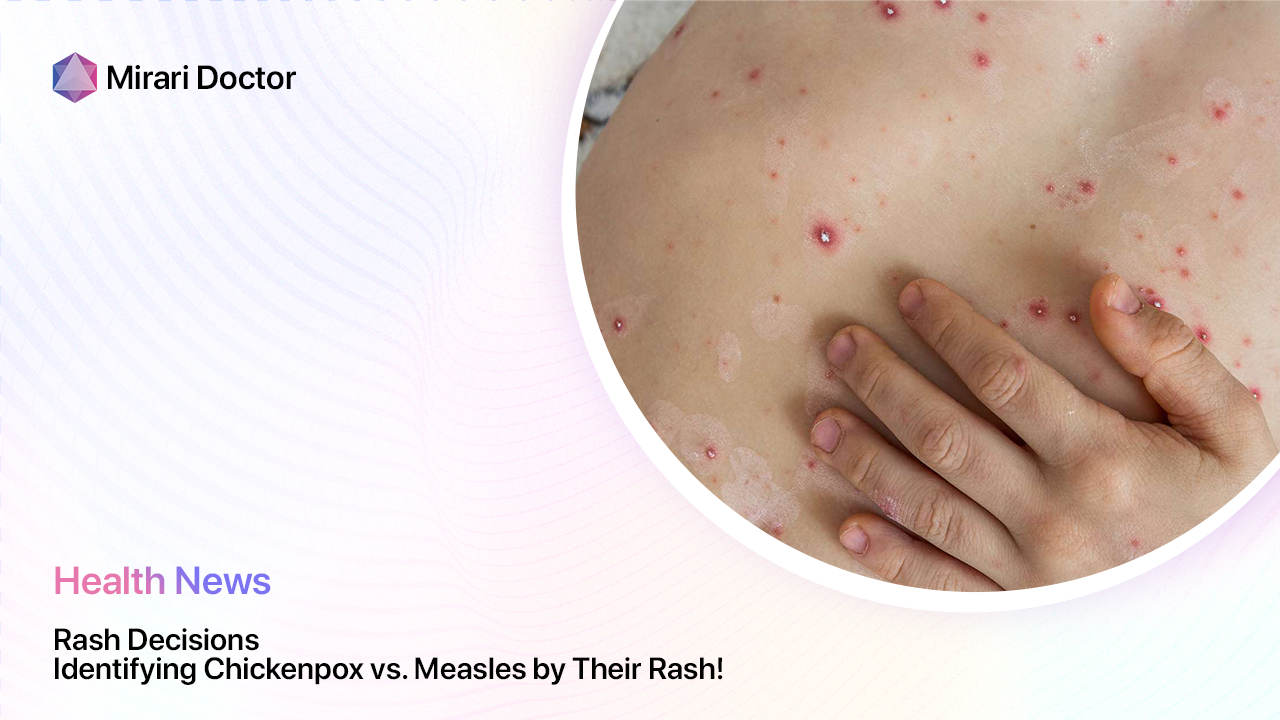 Featured image for “Rash Decisions: Identifying Chickenpox vs. Measles by Their Rash!”