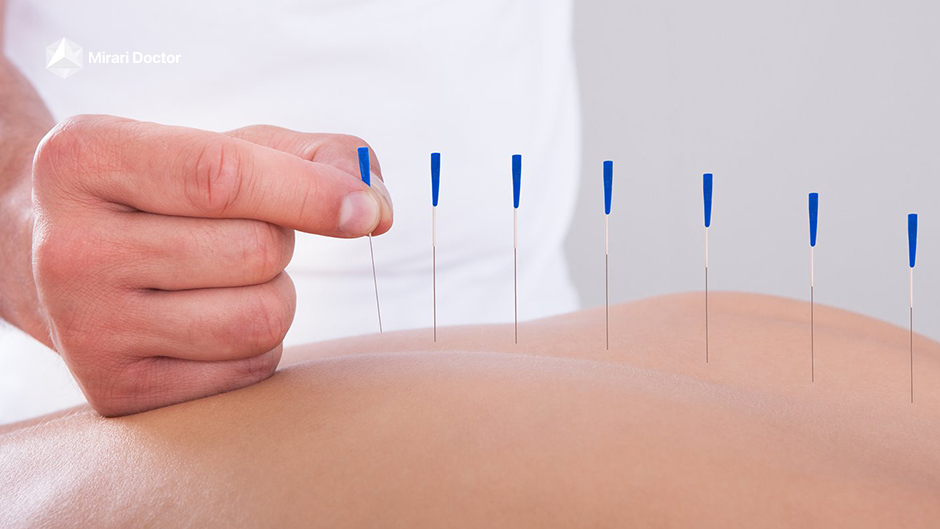 Acupuncture