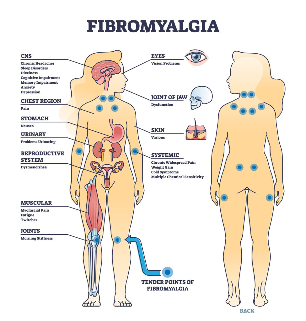 Fibromyalgiasymptoms HV