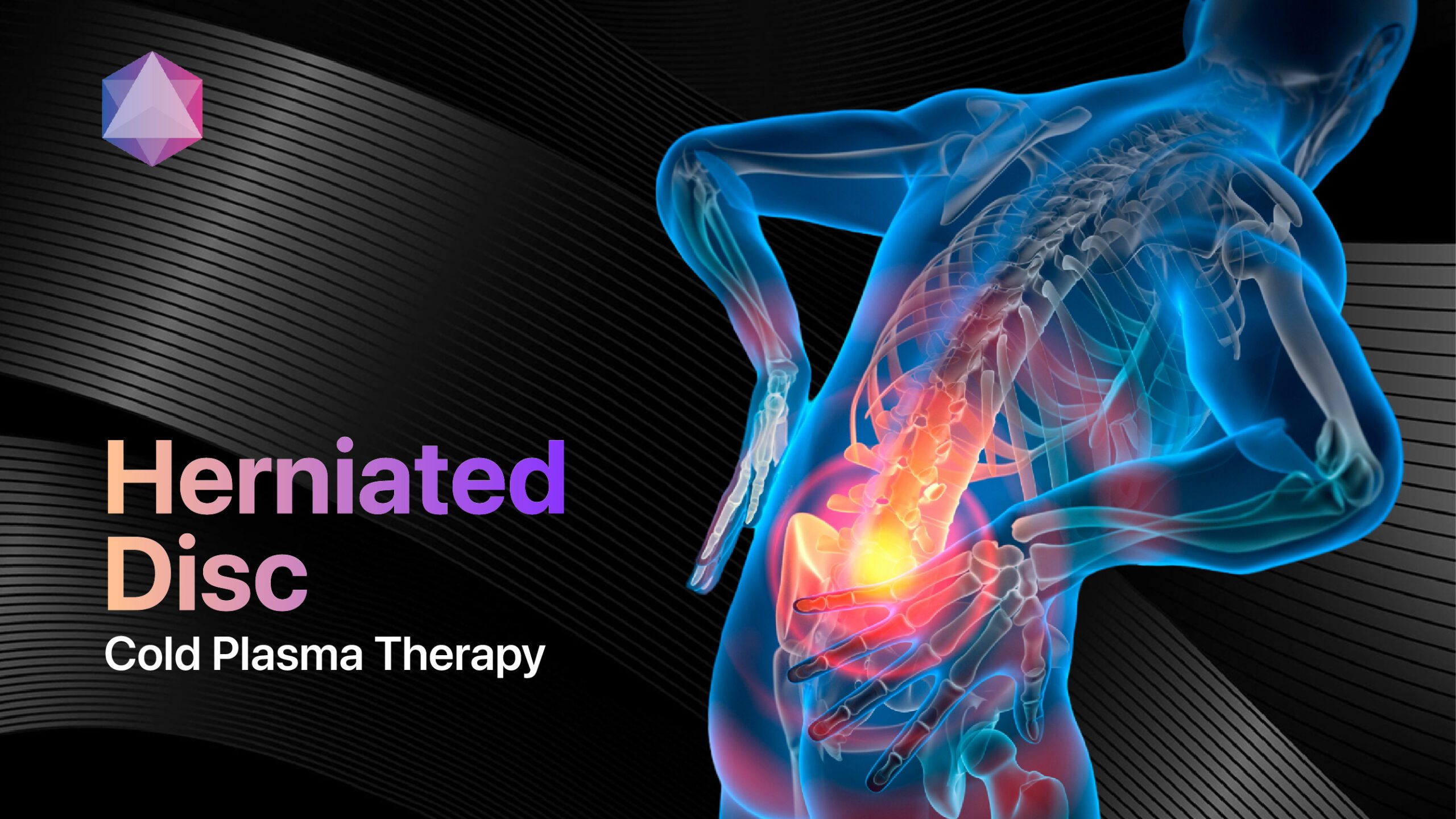 Featured image for “Herniated Disc Relief: The Power of Cold Plasma Therapy”