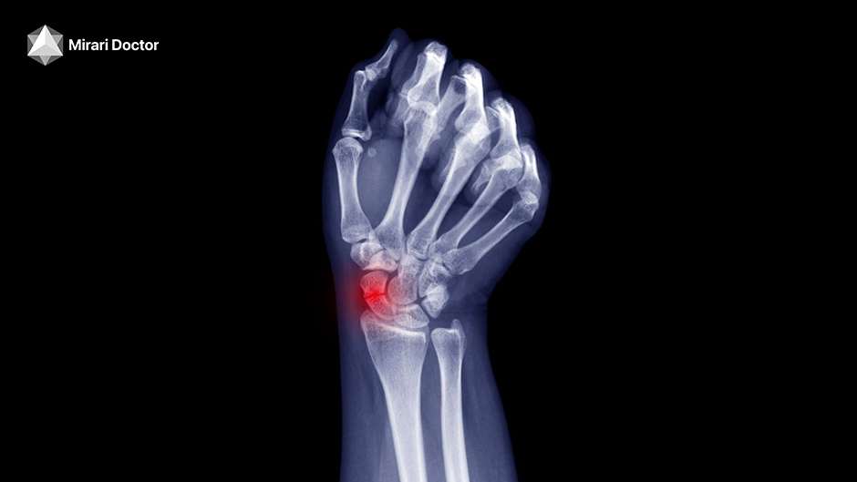 A wrist fracture