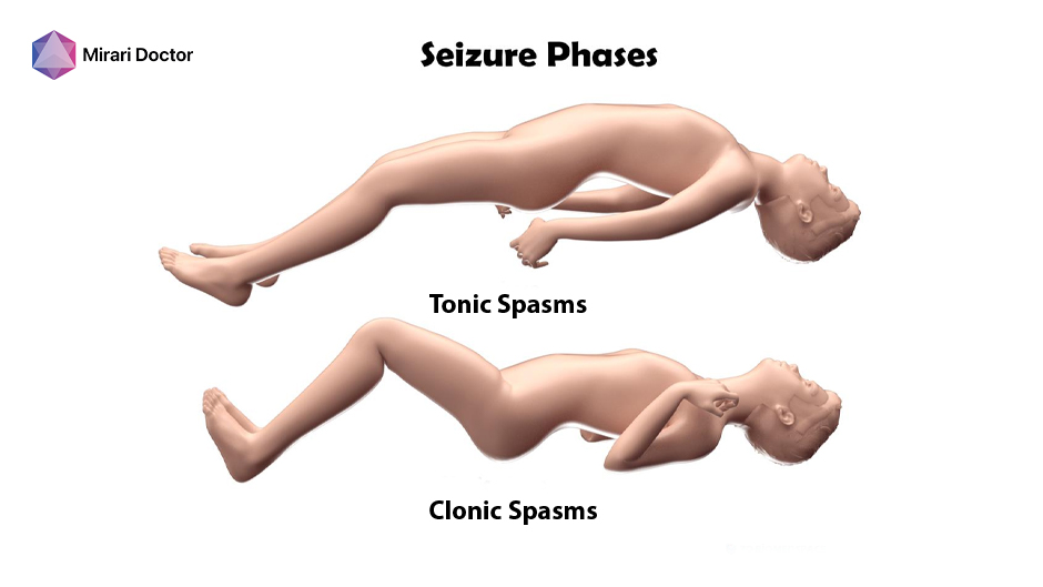 Clonic vs. Tonic Spasms