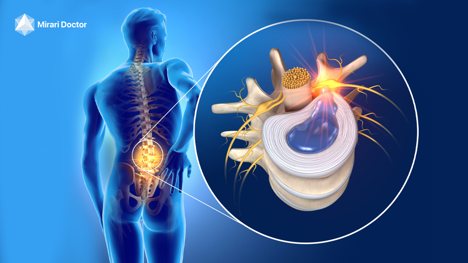 Herniated Disc